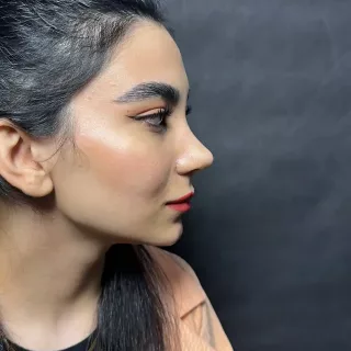 Rhinoplasty photo 14